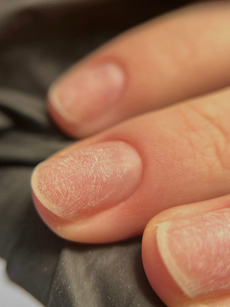 Nail Strengthening After Gel: close-up of weak, peeling nails immediately after gel polish removal